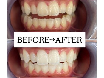 ホワイトニングサロン 宝塚/Before&After美白ホワイトニング