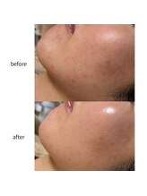 ルアラナ(Lualana)/アンストレス１回の変化