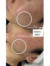 ナナイロサロン フクオカ(NaNairoサロン Fukuoka)/男性ヒゲ(wax＋光)ダブル脱毛