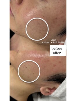 ナナイロサロン フクオカ(NaNairoサロン Fukuoka)/男性ヒゲ(wax＋光)ダブル脱毛