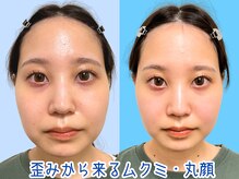 ナチュラルパーフェクトフェイス 新宿/丸顔・ムクミを整える/新宿小顔