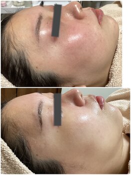 ザ フェース 東京目黒店(THE FAITH)/赤み、敏感肌改善