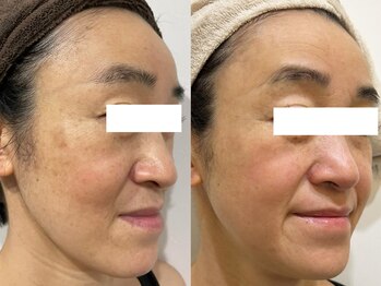 サクラ スパ(SAKURA SPA)/フェイシャル『ADSプログラム』