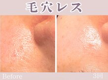 レッド(RED)/毛穴レス