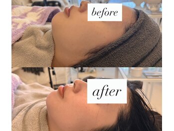 リノ(Lino)/肌質改善スキンケアプログラム