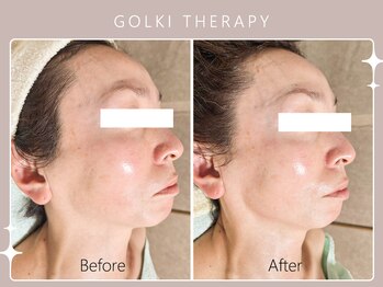 シロカネ イオンタウン西熊本店(SHIROKANE)/韓国式小顔コルギ☆