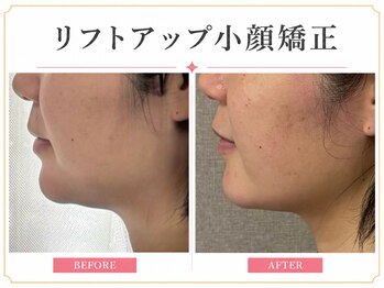 ビオエル(Bee'oele)の写真/リフトアップ小顔矯正・ふっくら艶肌ピーリングでたるみ改善！マイナス7歳印象肌へ◎