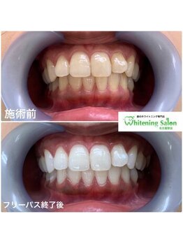 ホワイトニングサロン 名古屋駅店/【ホワイトニング施術例】