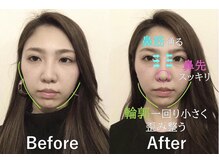 ラプリ 大宮店(Raplit)/隆鼻＋輪郭矯正40分10回