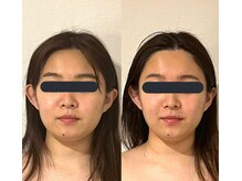 ハイコガオ(HIKOGAO)/小顔矯正40分