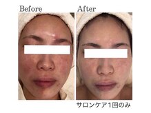 エラフリーの雰囲気（【結果を重視したケア】水素で深刻な悩み改善☆シミ・ニキビ緩和）