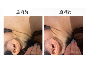 オアシスサカエ(OASIS SAKAE)/【襟足脱毛】