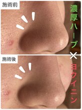 アリュール(ALLURE)/濃厚ハーブピーリングの施術効果