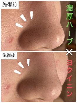 アリュール(ALLURE)/濃厚ハーブピーリングの施術効果