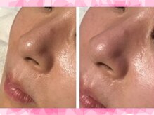 アイリープ(eyeleap)/☆ハイドロ毛穴洗浄