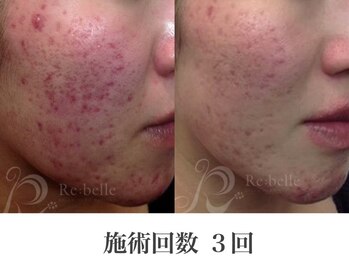 パルファンカルム 駅西本町店/根深いニキビにも効果抜群!