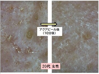 美肌プロジェクト カーラ 東川口店(CARA)/ハイドラフェイシャル直後◆20代