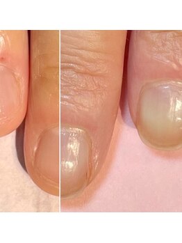 ココデネイル(cocode nail)/悩み:噛み爪(40代前半)その2