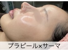 マドモアゼル 麻布十番/ララピール×サーマ