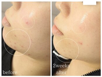 ラミーユ(La Miu)/肌質改善【二週間後の変化】