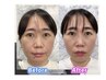 【リフトアップ、肌回復】今だけ！エクソソーム導入3000億 ¥39,800→¥15,500