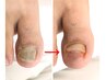 【足の悩み/変形爪/爪の変色/厚い爪/様子が変な爪】変形した爪のケア2回目