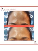 ナル ゆあん鍼灸接骨院(nalu)/ララピール◇しわ改善効果