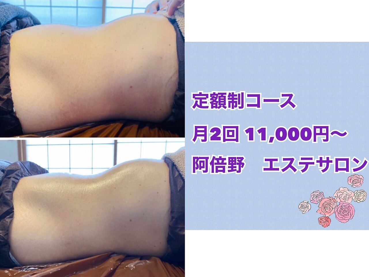 大阪市阿倍野区でキャビテーションが人気のエステサロン