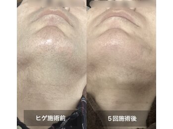 リリー(RILY)/【ビフォーアフター】