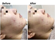 ムーロ バイ ミュー(muro. by mieux)/ハーブピーリング