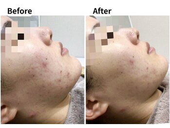 ムーロ バイ ミュー(muro. by mieux)/ハーブピーリング