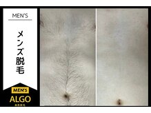 アルゴ 越前店(ALGO)/メンズ脱毛 before after