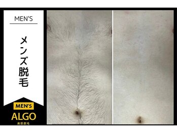 アルゴ 越前店(ALGO)/メンズ脱毛 before after