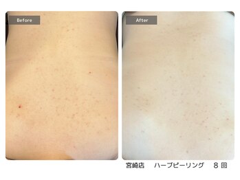 エミルカ 宮崎店(EMILUCA)の写真/【ブライダルハーブピーリング】一大イベント、結婚式を彩る！ドレス映えするお肌で後ろ姿も自信◎