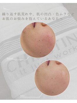 シャルム(Charme)の写真/繰り返す肌荒れに。
原因を見極め、一緒に肌を育てる肌質改善ケア