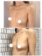 美人バスト アンド ヒップアップ 広島店/バストアップ症例写真