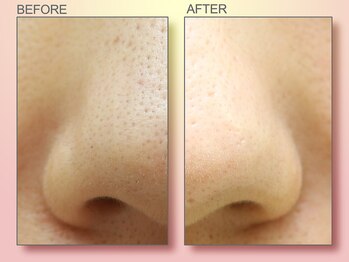 ジュリア オージェ 難波店/ビフォーアフター（鼻スパ）