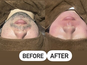 ソーレエルーナ(SOLE e LUNA)/メンズ 新宿 ヒゲ 髭 ひげ 脱毛