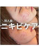 骨盤ダイエットサロン カンフリエ(camphrier) ピーリング 毛穴洗浄