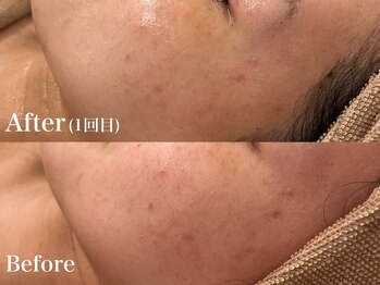 シャルム(Charme)/メンズフェイシャル♪ニキビケア