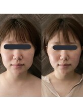 ハイコガオ 中崎町店(HIKOGAO)/小顔矯正