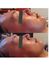 メイリリーブラン(MayLily-Blanc)/プラズマエステ