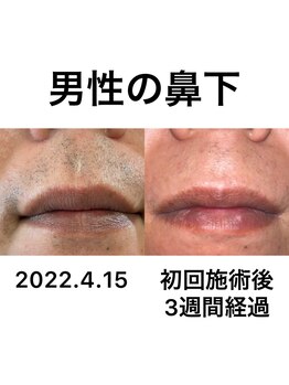 アシヤ髭ラボ(ASHIYA 髭 LABO)/ヒゲ脱毛ビフォーアフター