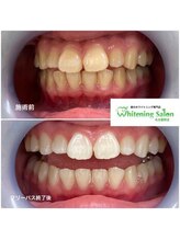 ホワイトニングサロン 名古屋駅店/【ホワイトニング施術例】