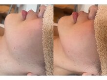 ビューティーマックス(Beauty Max)/フェイシャルbefore→after 1回