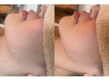 ビューティーマックス(Beauty Max)/フェイシャルbefore→after 1回