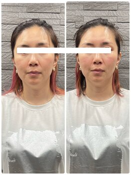 長寿鍼灸院 長寿整骨院/美容鍼50本の効果★小顔効果