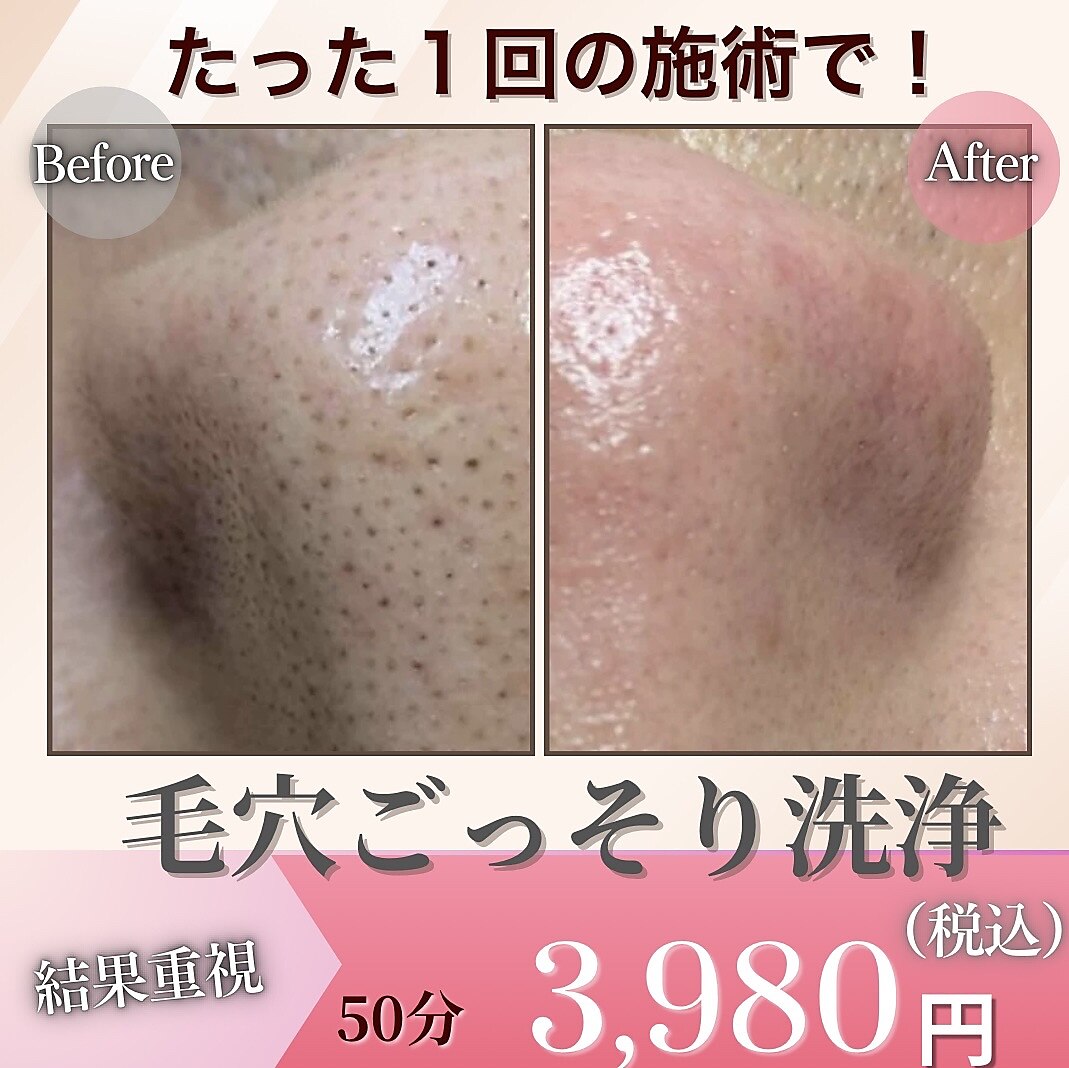 札幌市豊平区で毛穴洗浄・毛穴吸引が人気のエステサロン