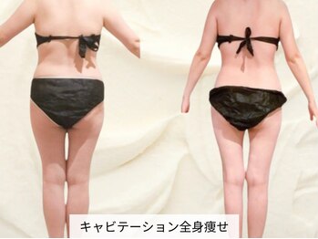 トレゾール(tresor)/【痩身】赤坂痩身エステtresor