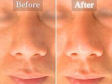 ボーンオム(Born Homme)/毛穴洗浄＋美容液導入：40代男性